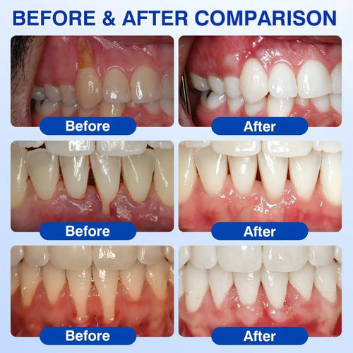 GUMORA™ Advanced Gum Care Gel